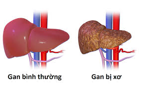 Bệnh xơ gan có chữa được không